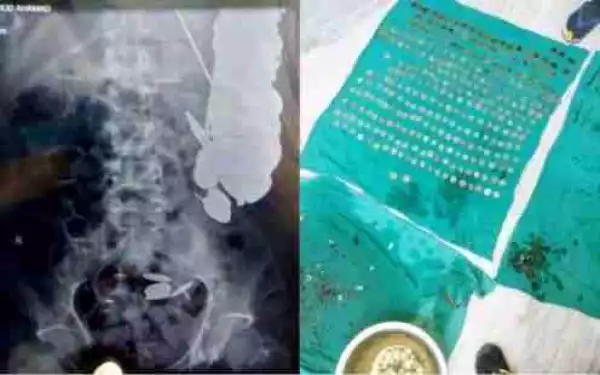 Unbelievable: Medical Doctors in Shock as They Remove 263 Coins from a Man